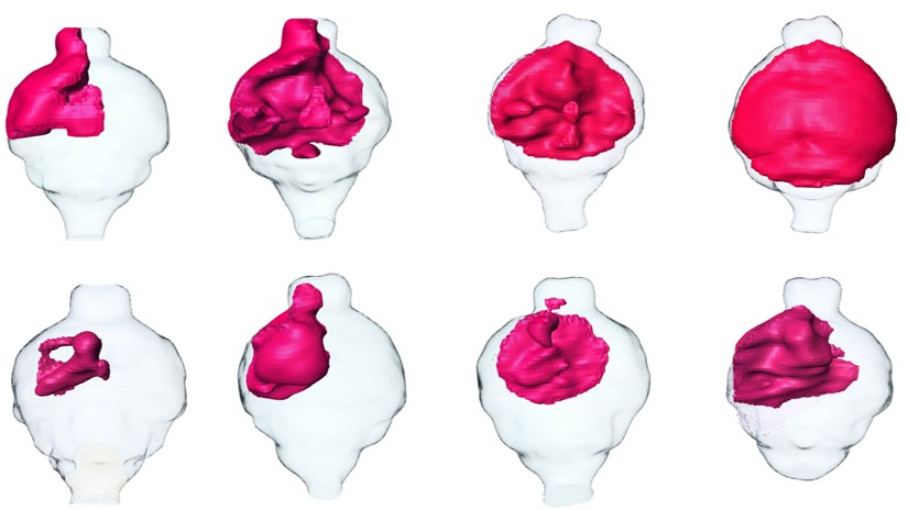 MRI renderings of mouse brain tumors. Tumors treated with SKOG102 (lower panels) shrank by about half compared to tumors treated with a control (upper panels).