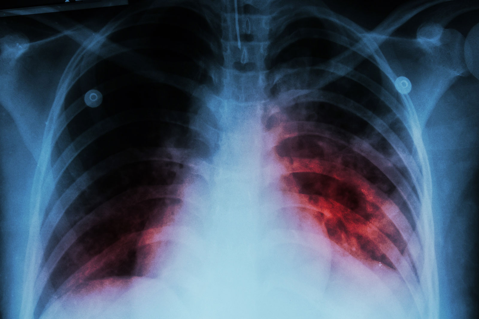 Chest xray showing areas of infection