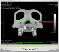 Interactive annotation can be used to perform virtual studies on CT scan data. Using OsiriX visualization software, the length measurement annotation tool is used to take instant measurements on a CT scan of a chimpanzee skull, providing researchers a valuable analysis tool without ever handling the actual physical specimen. Source: John L. Moreland, San Diego Supercomputer Center, UC San Diego.